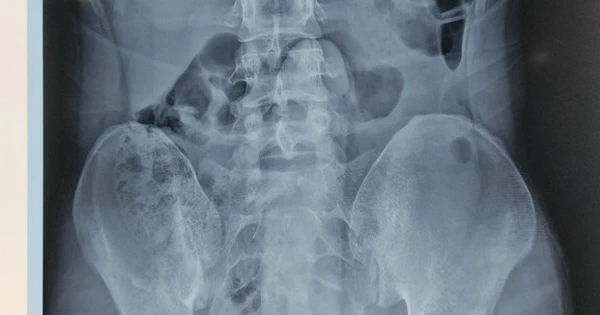 Chuyện bất ngờ: Trực tràng nam thanh niên chứa kỳ đồ chơi tình dục