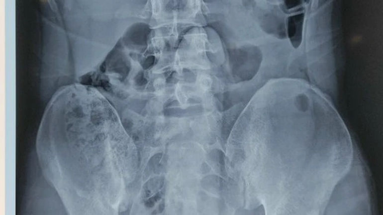 Chuyện bất ngờ: Trực tràng nam thanh niên chứa kỳ đồ chơi tình dục