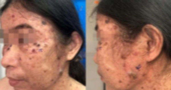 Ngộ độc da hiếm gặp: Kỳ quan khám phá loạn sản thượng bì dạng hạt cơm tiến triển thành đa ung thư da