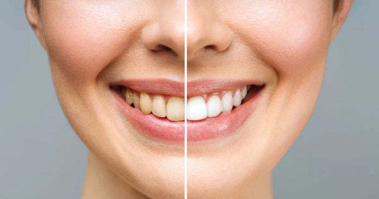 Unveiling the Ultimate Prime Day 2023 Teeth Whitening Deals That Will Brighten Your Smile!
