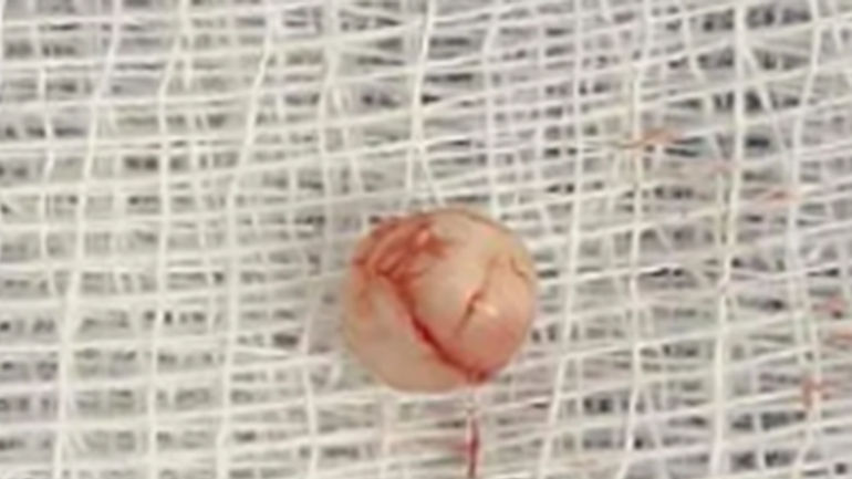 Cách thực hiện hiệu quả việc điều trị dị tật bẩm sinh hiếm gặp, tỷ lệ chỉ 0,12/100000 ca cho trẻ 3 tuổi