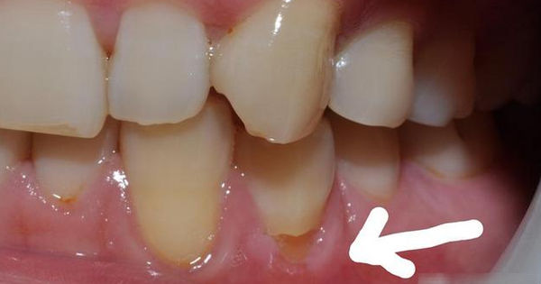 Nguyên nhân răng vỡ rụng do cách đánh răng không đúng