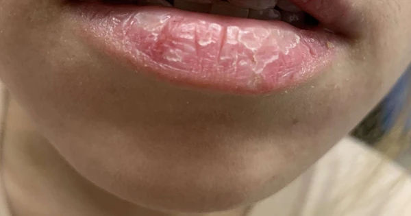 Môi 23 tuổi bị nứt nẻ tới mức 'như vỏ cây' sau hơn 10 lần đánh son mỗi ngày