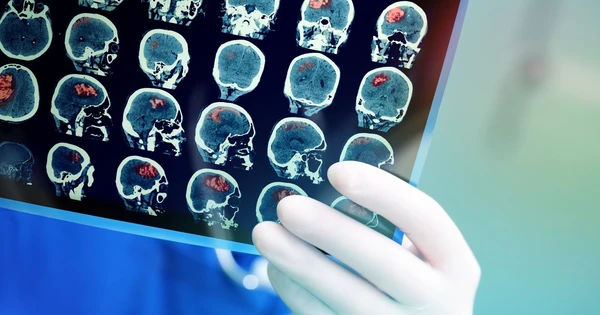 6 nguyên nhân khiến nguy cơ đột quỵ tăng cao ở người trẻ: Không thể bỏ qua!