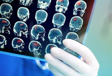 6 nguyên nhân khiến nguy cơ đột quỵ tăng cao ở người trẻ: Không thể bỏ qua!