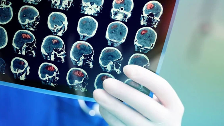 6 nguyên nhân khiến nguy cơ đột quỵ tăng cao ở người trẻ: Không thể bỏ qua!