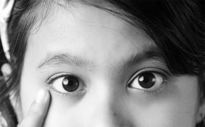 Close-up of a patient's eyes during an eye health evaluation