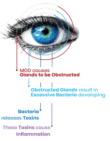 Diagram showing how blocked meibomian glands can cause bacteria buildup, toxins, and eye inflammation
