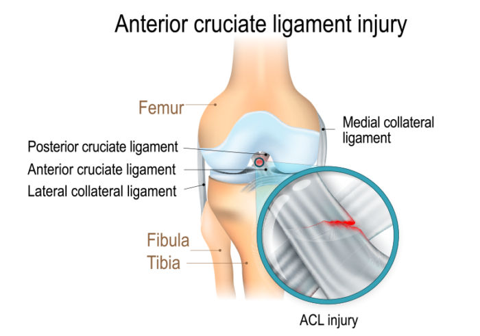 ACL Reconstruction, Central Florida Orthopedic Doctor