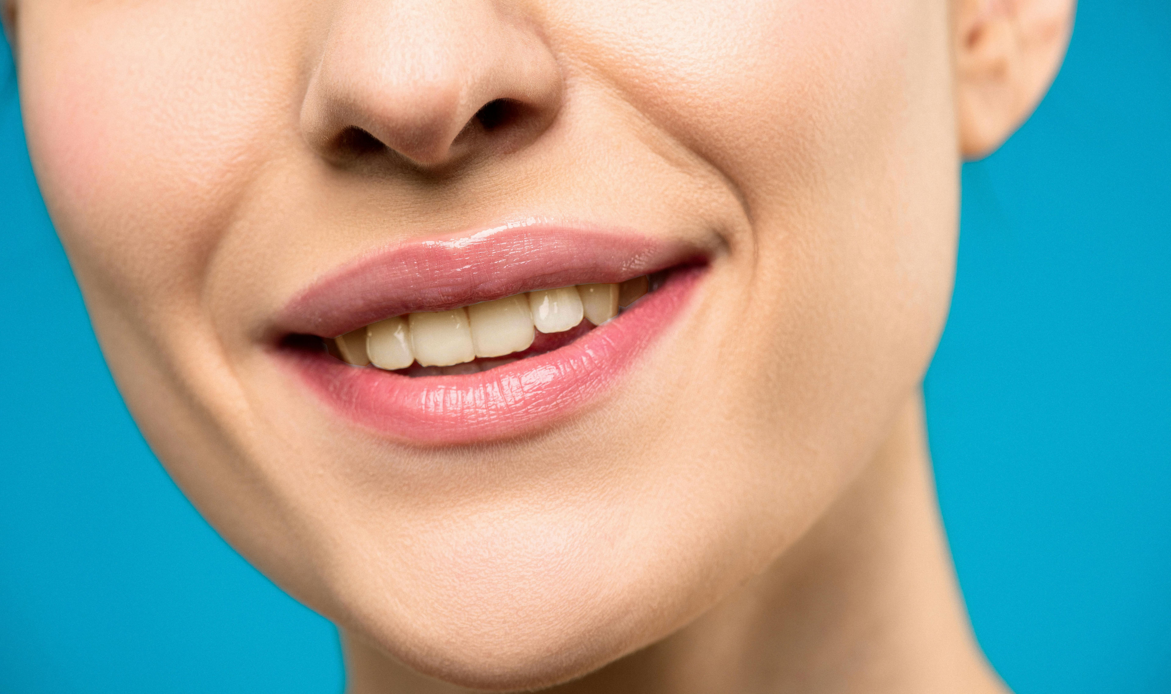 Aesthetic misalignment before veneers treatment