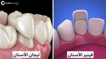الفرق بين تيجان الأسنان و الفينير