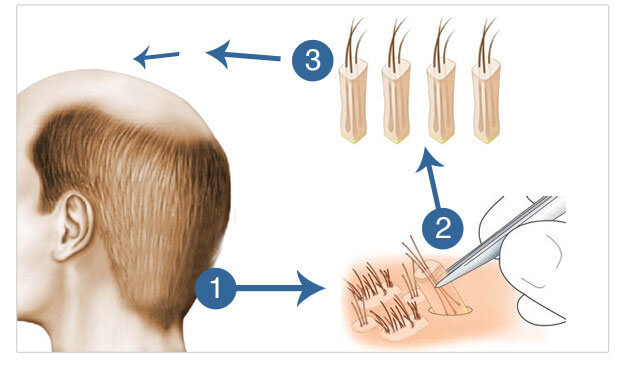 FUE (Follicular Unit Extraction) Technique used in Delhi