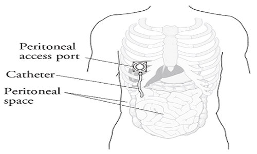 intraperitoneal