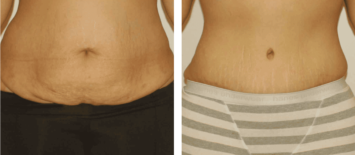 Tummy Tuck Cost in Turkey - 2024 Price Comparison