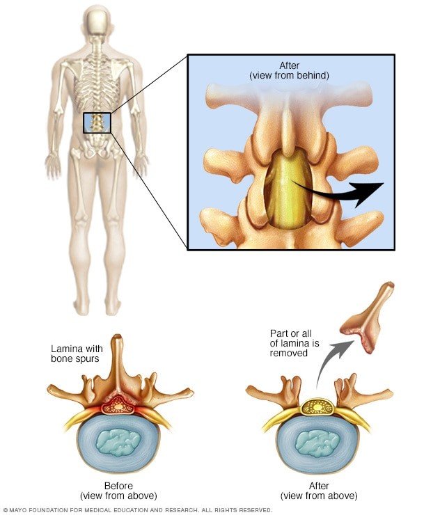 Laminectomy surgery