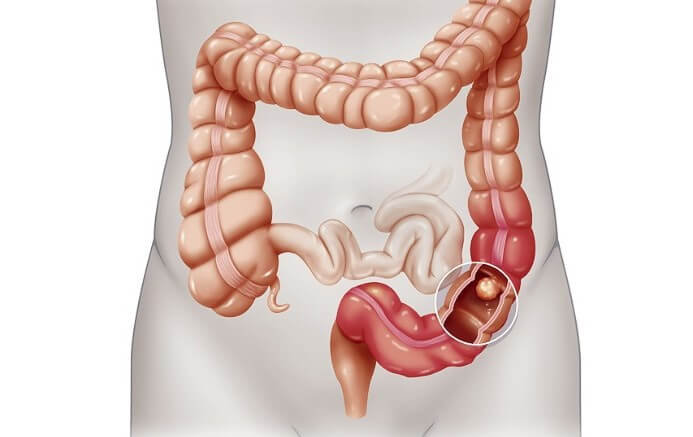 Colon-cancer