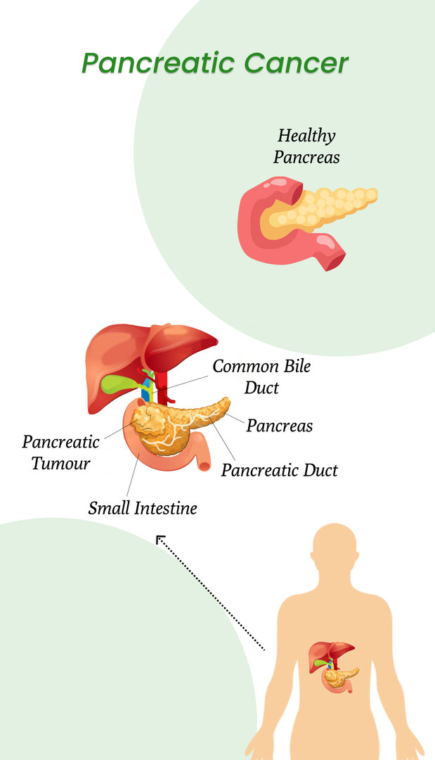 Exploring New Pancreatic Cancer Treatments Breakthroughs and Hope