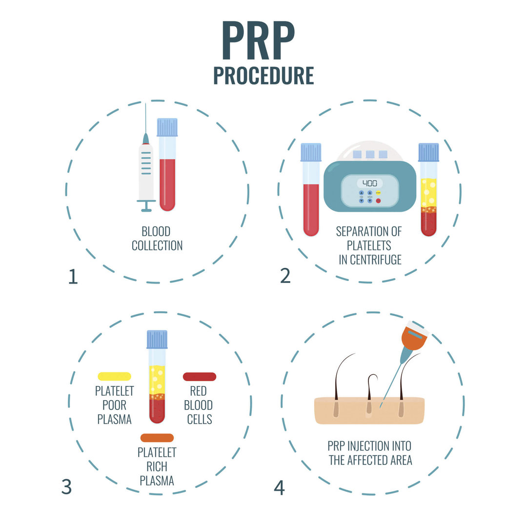 Platelet Rich Plasma (PRP) Technique used in Delhi