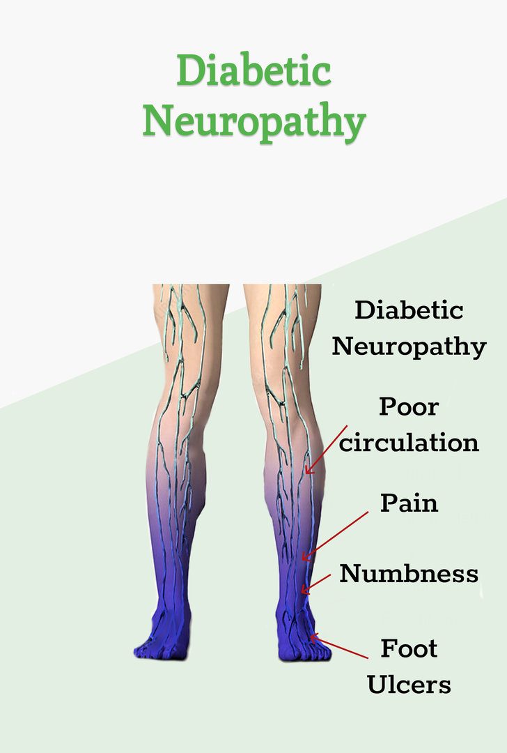 Diabetic Neuropathy