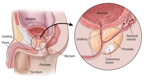 prostate-cancer