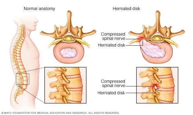 Discectomy