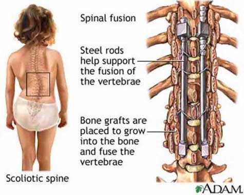 Spine fusion