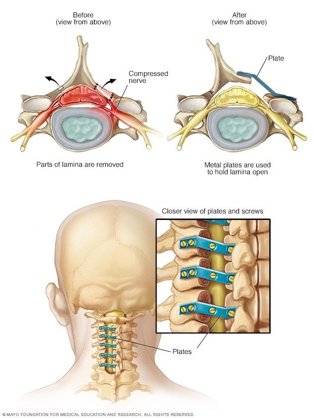 Lumbar Spine Surgery