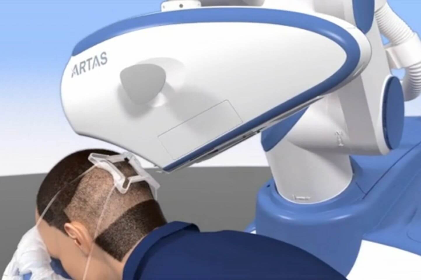 Robotic Hair Transplant Technique used in Delhi