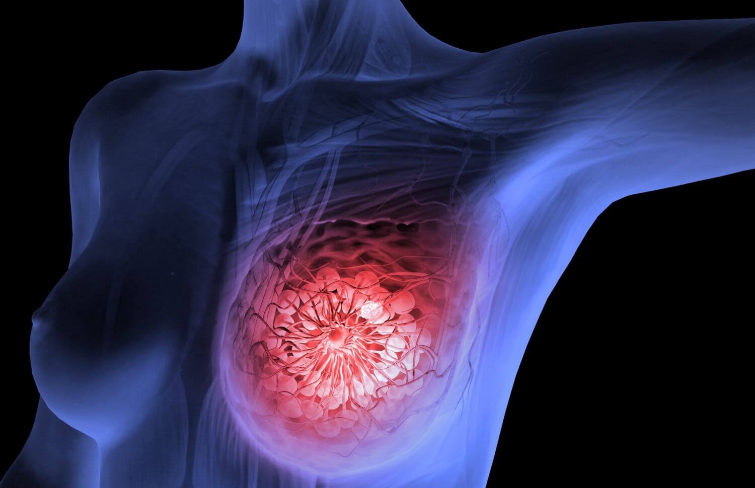 Breast-cancer