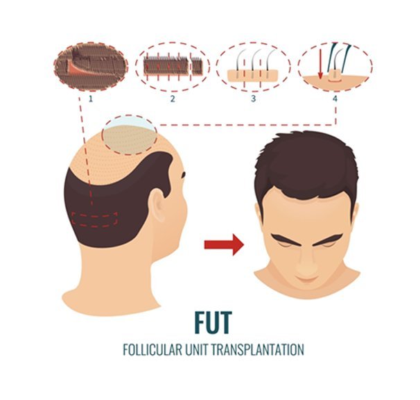 FUT Hair Transplant Toronto