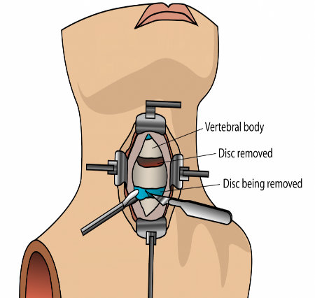 Cervical Spine Surgery