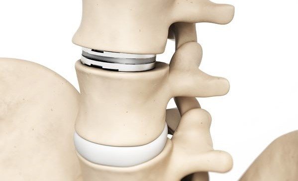 Spinal disc replacement