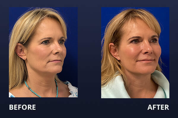 Facelift Before &amp; After Pictures | Madnani Facial Plastic Surgery