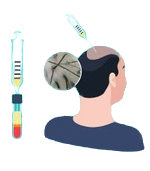 PRP Hair Treatment