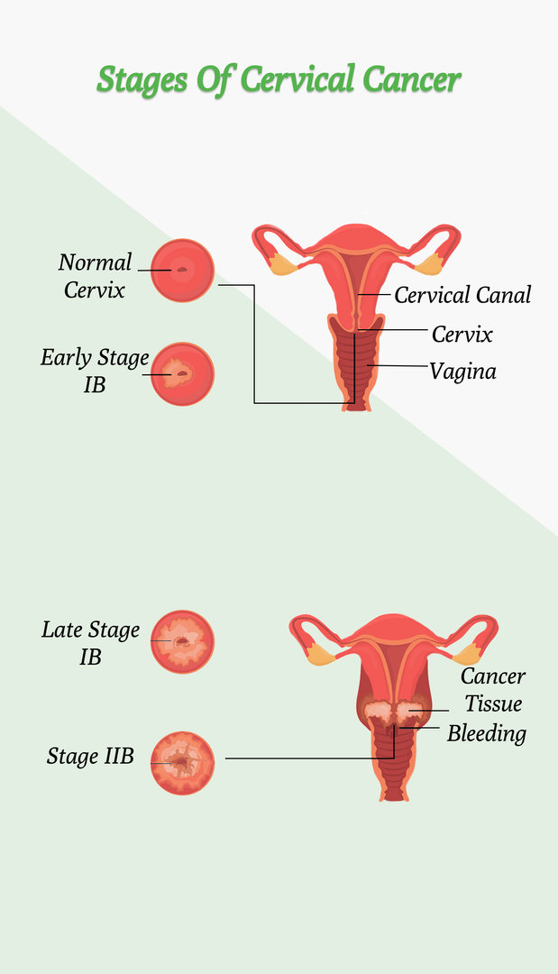 Stages of Cervical Cancer