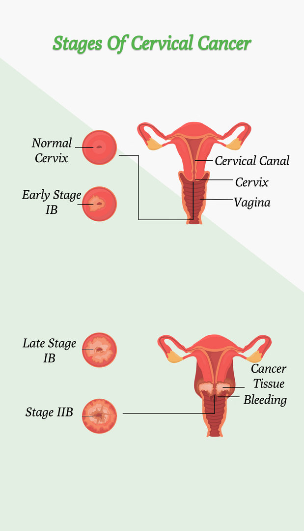 Stages of Cervical Cancer