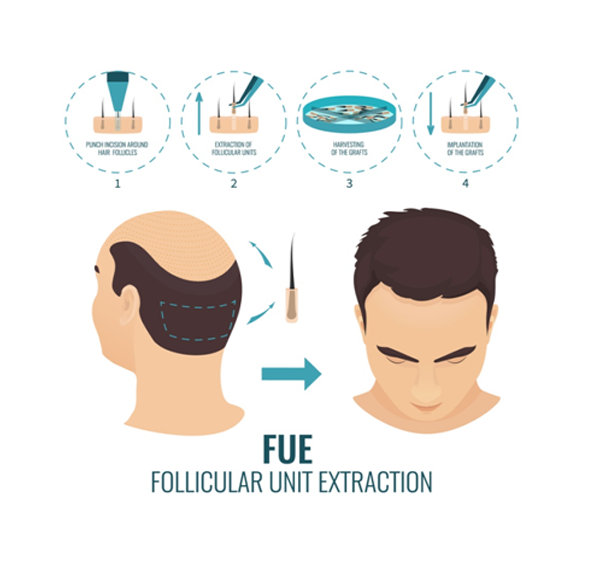 FUE (استخراج وحدة البصيلات)