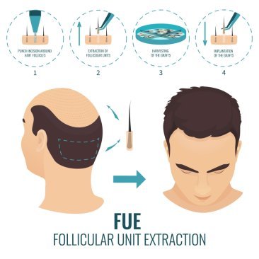 Follicular Unit Extraction (FUE)