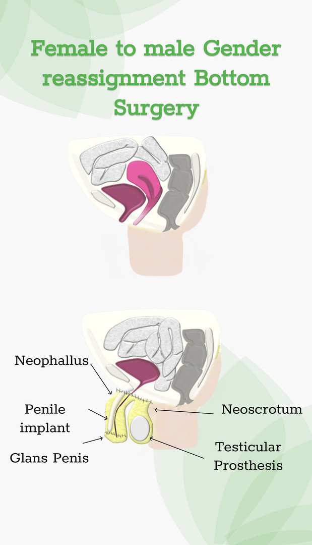 Cost of Female-to-Male Bottom Surgery