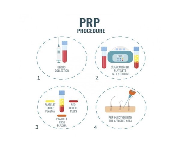 PRP hair treatment Toronto