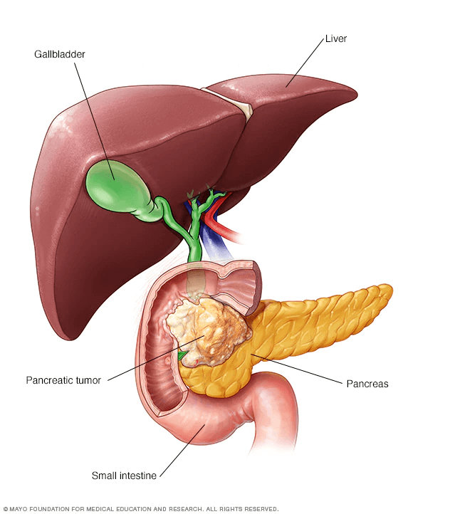 Pancreatic-cancer