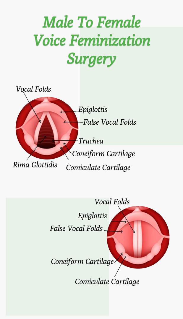 male to female voice feminization surgery