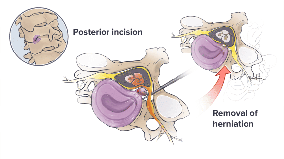 Cervical Spine Surgery