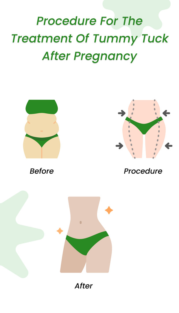 Tummy tuck after pregnancy- Is it safe and effective?