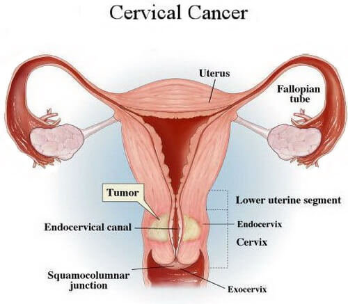 Cervical-cancer