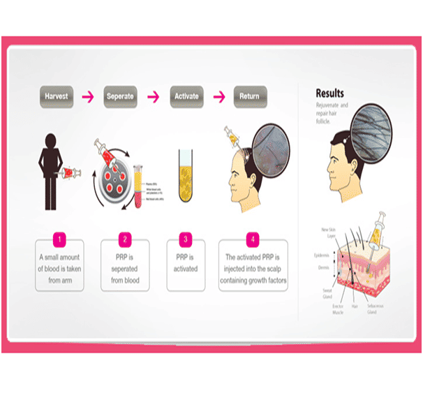 PRP (Platelet-rich Plasma) therapy