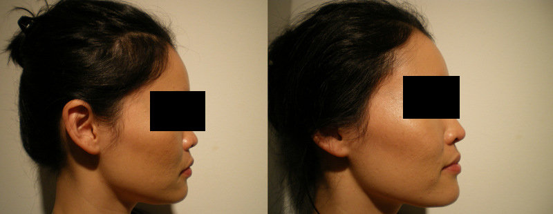 ملف: NonSurgicalRhinoplasty3.jpg - ويكيميديا كومنز