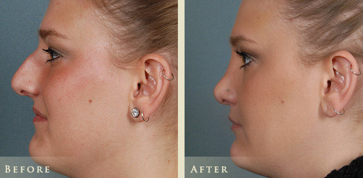 Aesthetic Rhinoplasty Before and After | Colorado Plastic Surgery