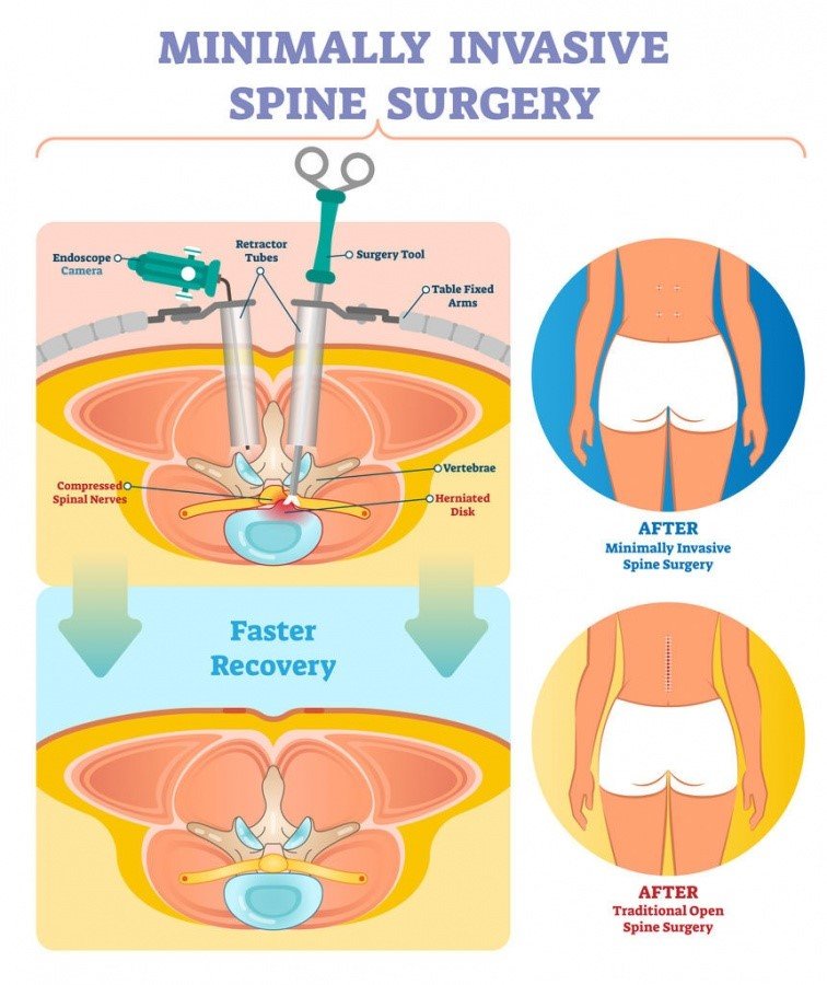 Minimally invasive spine surgery (MISS)