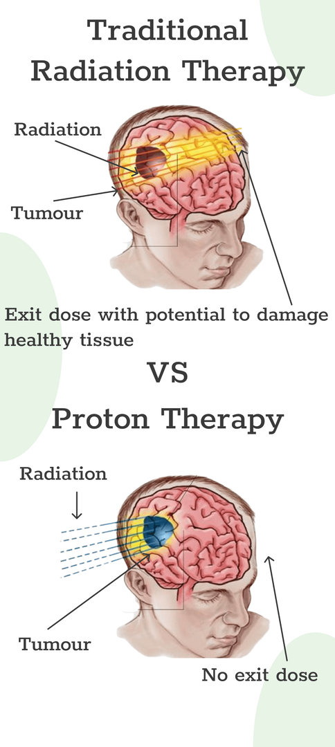 proton therapy a better alternative to traditional radiation therapy